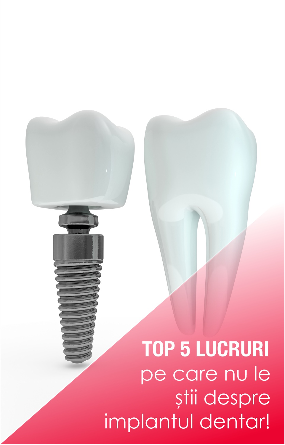 Top 5 lucruri pe care nu le știi despre implantul dentar!