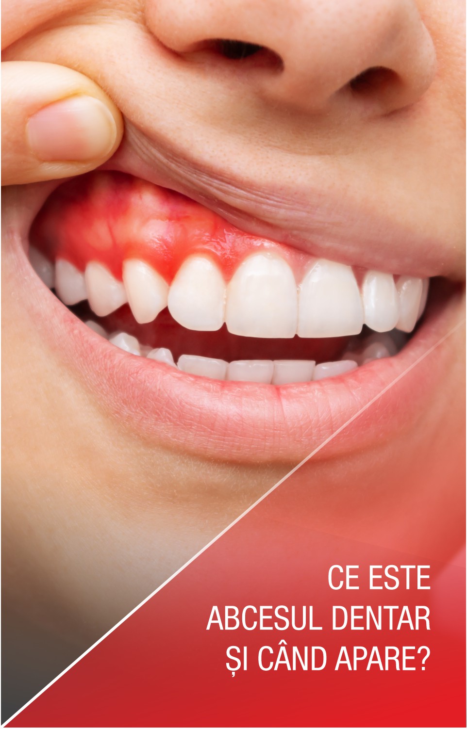 Ce este abcesul dentar și cum poate fi tratat?
