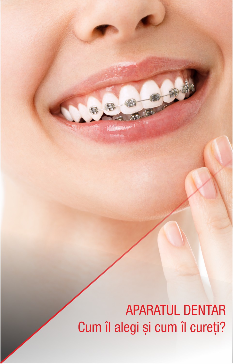 Aparatul dentar: cum îl alegi și cum îl cureți?